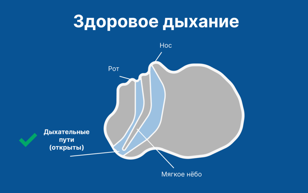 Причина храпа — сужение дыхательных путей