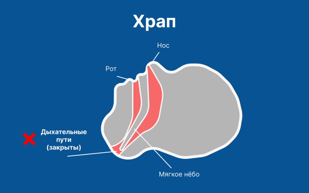 Как избавиться от храпа самостоятельно